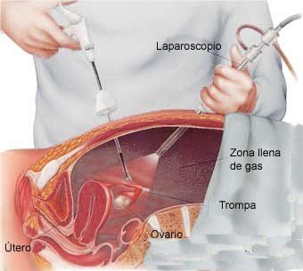 chirurgia ginecologica, cisti ovarica, cancro utero, cancro ovaio, prolasso utero, prolasso vescica