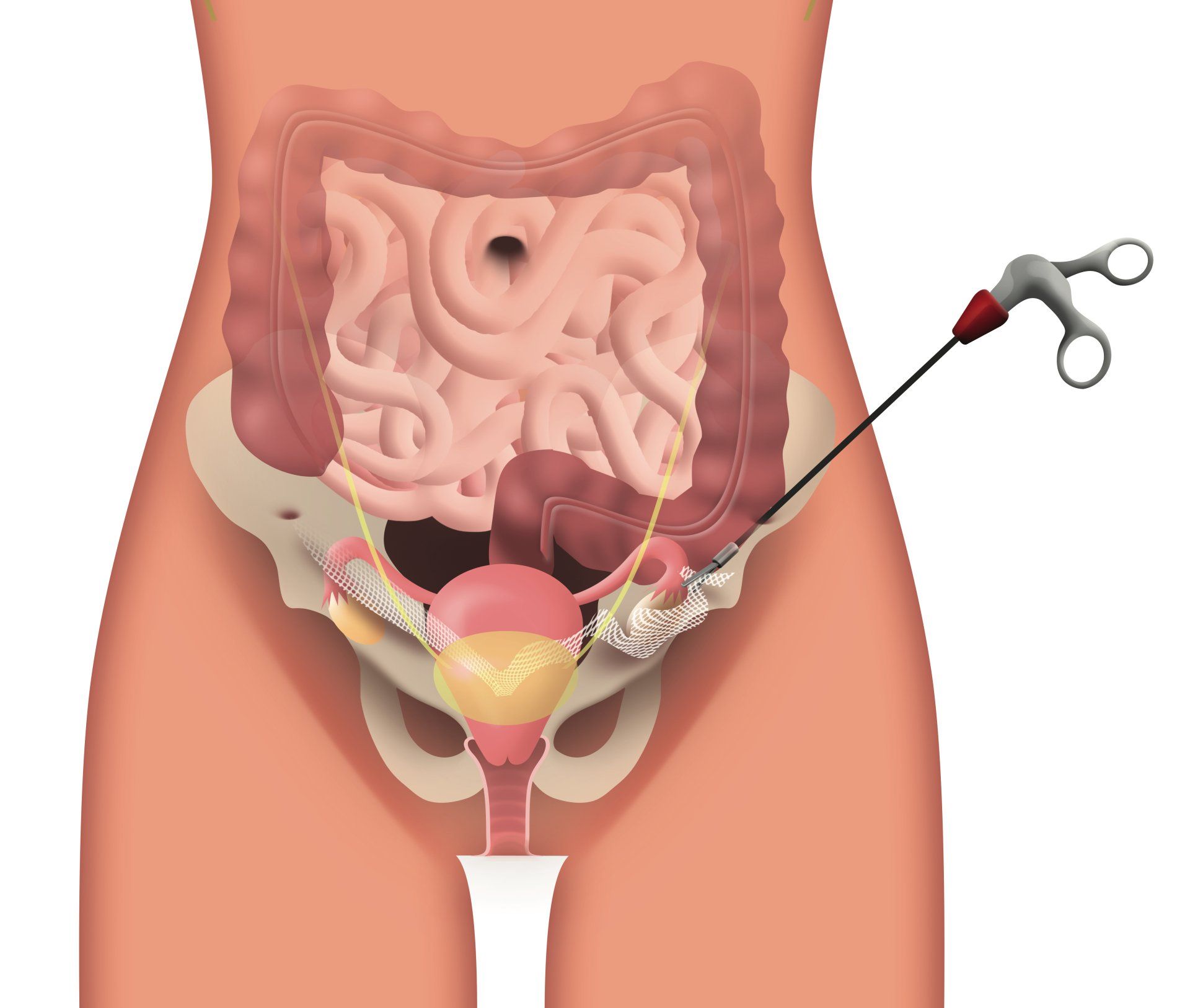 sospensione degli organi pelvici laparoscopica, laparoscopic sospension pelvic organs prolapse, POPS