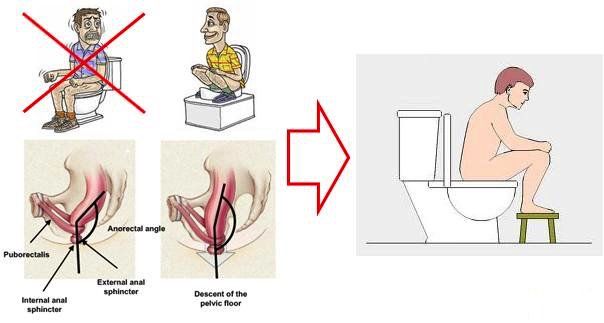 malattia emorroidaria - emorroidi - prolasso emorroidario - prolasso muco emorroidario - trombosi emorroidaria - varicosi emorroidaria - sanguinolento retto - sanguinolento ano - dolore ano - prurito ano