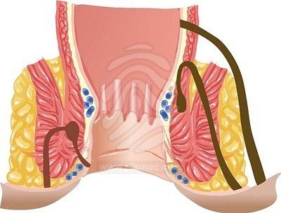 malattia emorroidaria - emorroidi - prolasso emorroidario - prolasso muco emorroidario - trombosi emorroidaria - varicosi emorroidaria - sanguinolento retto - sanguinolento ano - dolore ano - prurito ano