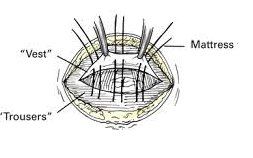 Riparazione ernia ombelicale
