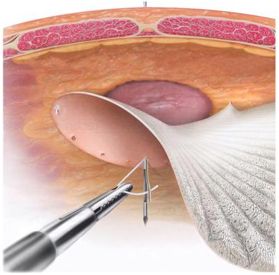Riparazione ernia ombelicale