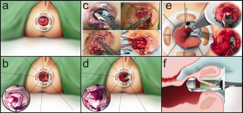 resezione tranasanale del retto - prolassectomia con stapler - chirurgia emorroidi - tecnica di Longo - resezione prolasso emorroidario