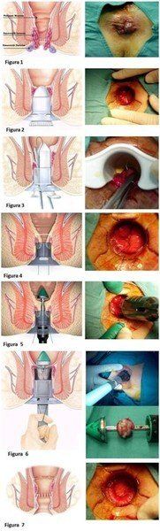 prolassectomia con stapler - chirurgia emorroidi - tecnica di Longo - resezione prolasso emorroidario