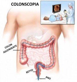 Colonscopia, Cancro del Colon, Cancro del Retto, Colon, Pancolonscopia