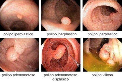 Polipi del colon, cancro colon, colonscopia