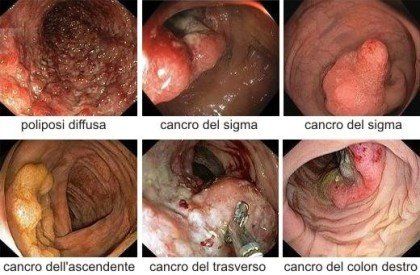 Polipi del colon, cancro colon, colonscopia, cancro retto, poliposi colon