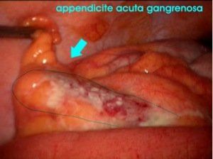 appendicite - appendicectomia - peritonite - ascesso appendicolare
