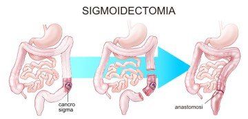 Sigmoidectomia o resezione del sigma