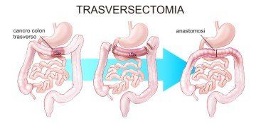 Trasversectomia o resezione del trasverso