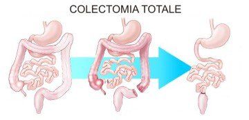 Colectomia Totale