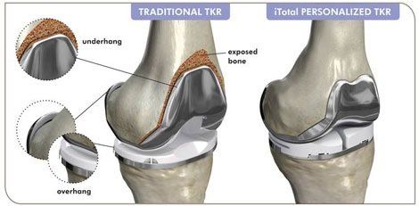 customized-total-knee-replacement