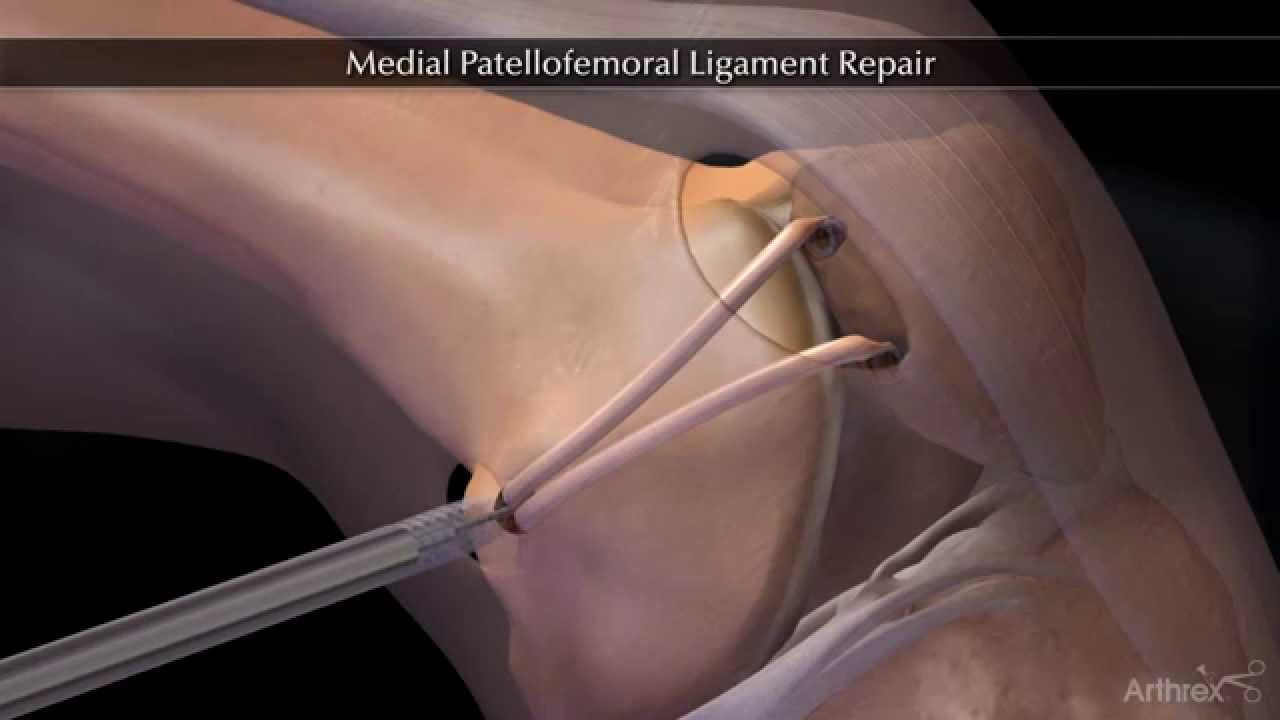 pattelar-instability