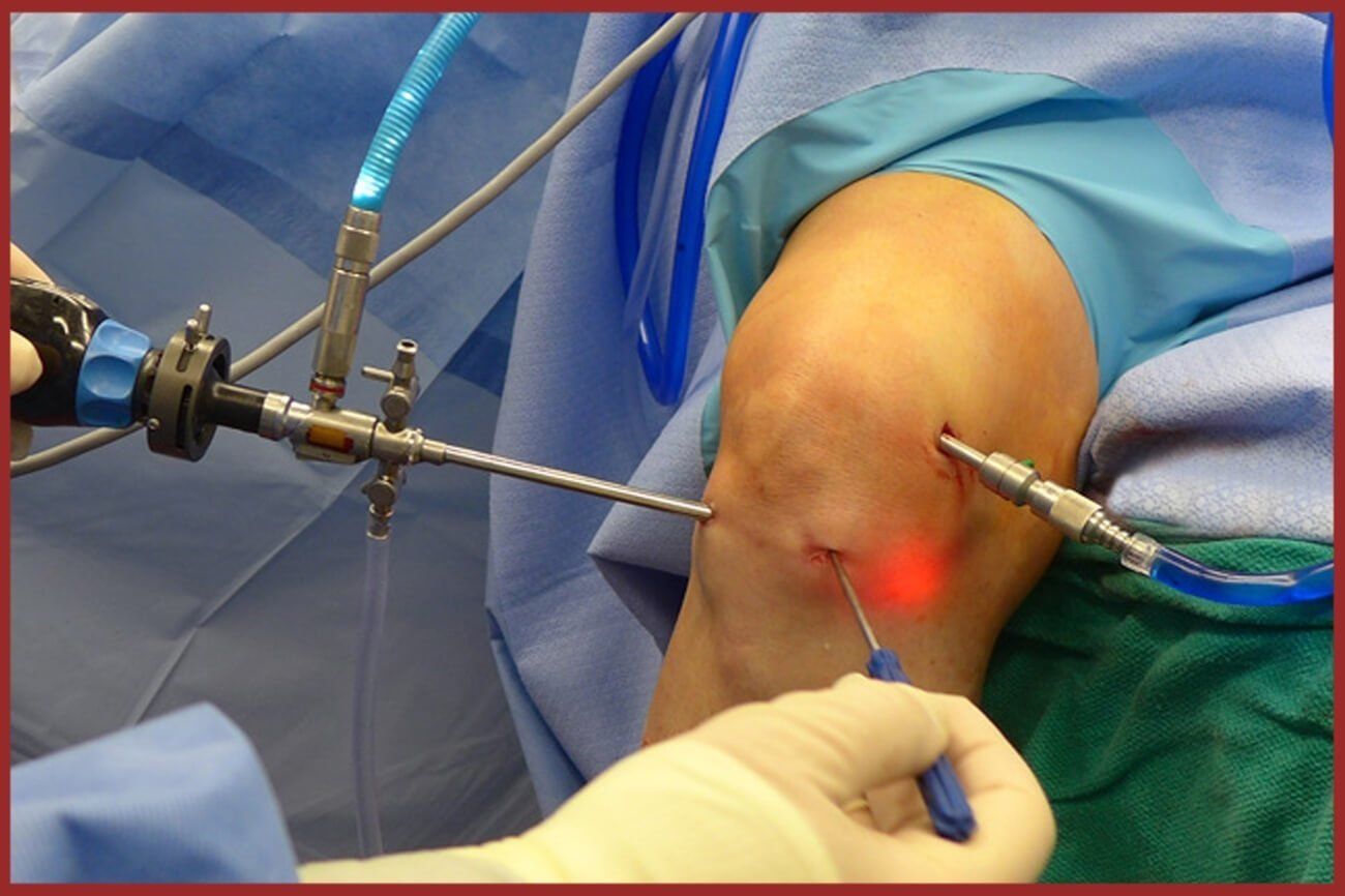 keyhole-knee-surgery