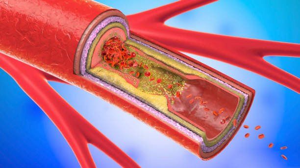 Controlar el colesterol previene la obstrucción de las arterias Controlar el colesterol previene la obstrucción de las arterias
