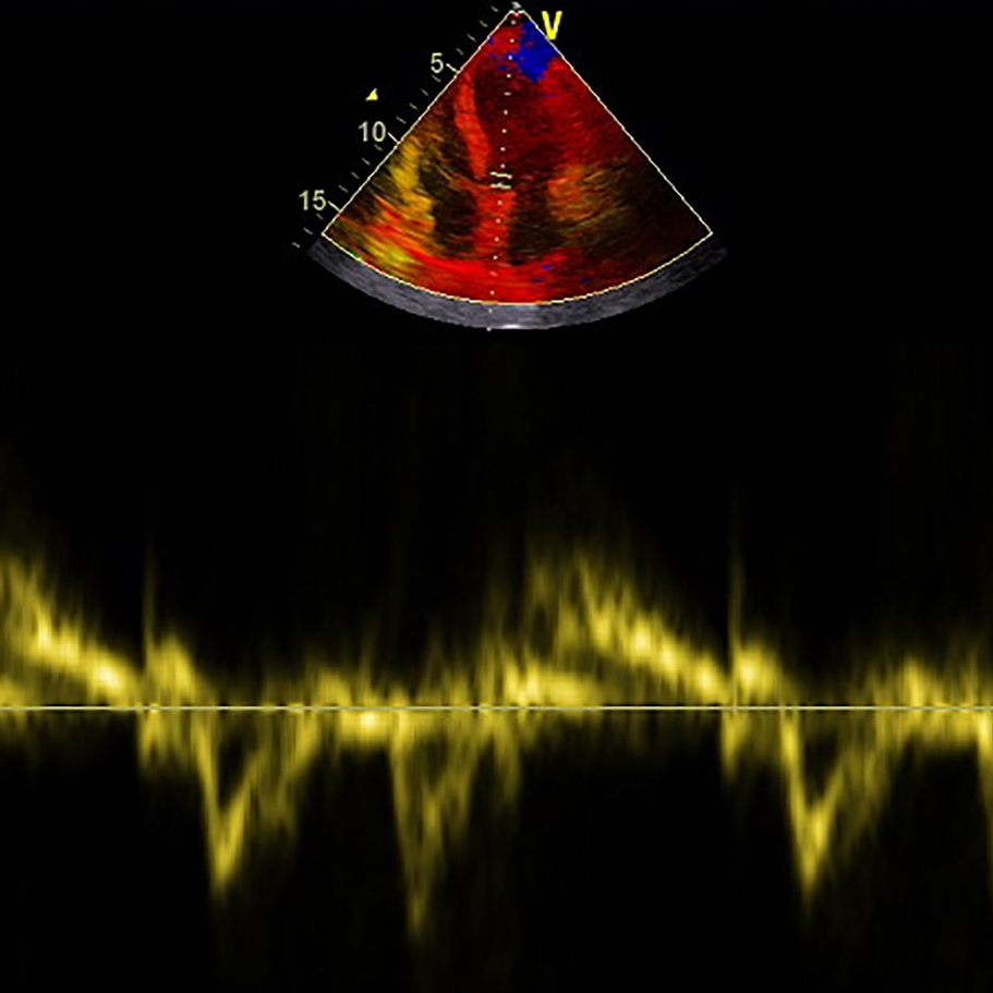 Echo, Herzultraschall, Echokardiographie, Herzklappen, Pumpleistung, Herzgeraeusch, Gewebedoppler, Doppler, CW, PW
