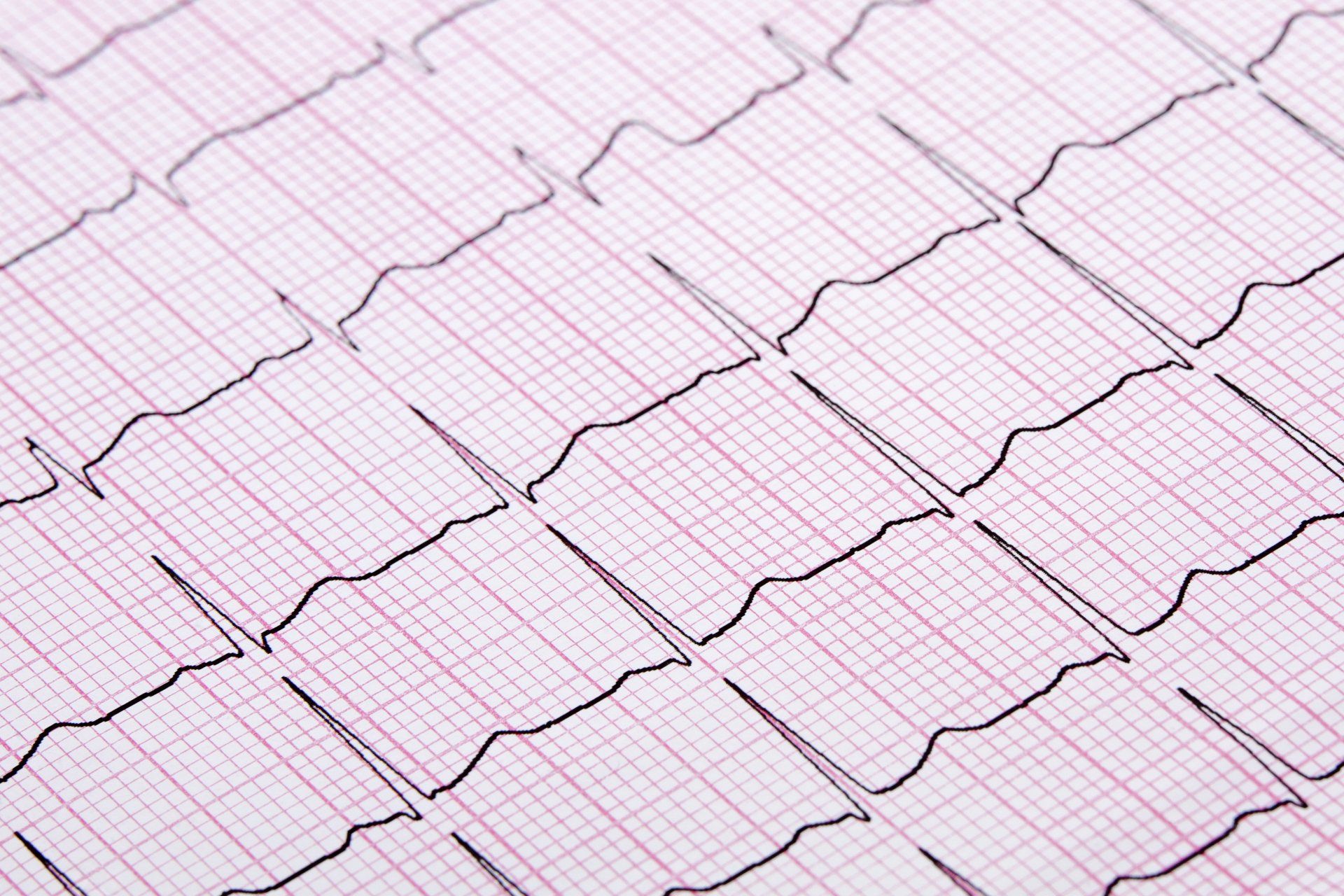 EKG, Rhythmus, Puls