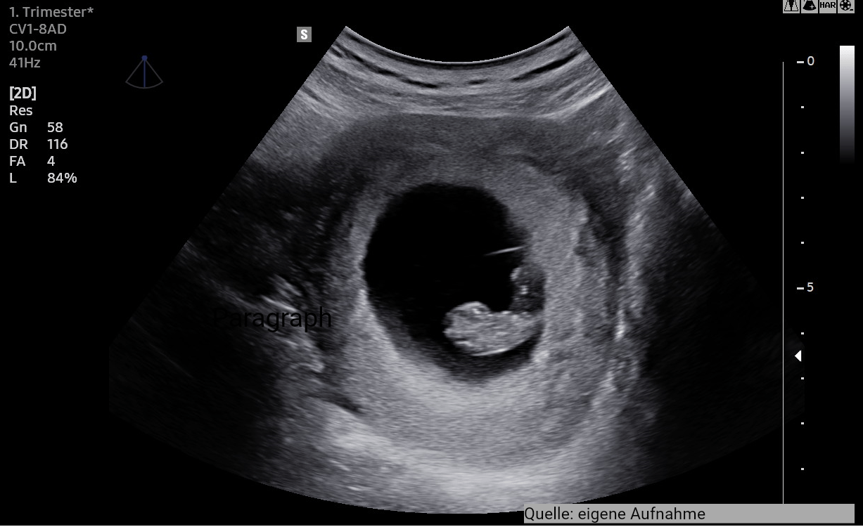 Unauffällige Schwangerschaft in der 9. SSW. Quelle: eigene Aufnahme
