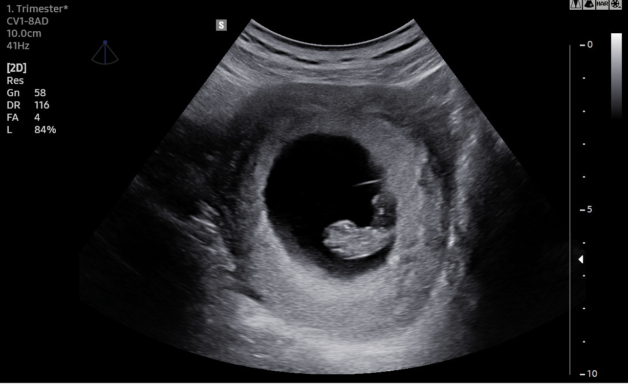 Embryo in der 9. SSW, wenige Details erkennbar