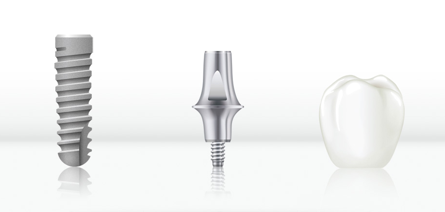 Implantat und Qualität bei Praxis Dr. Kadir Aksogan, R