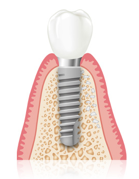 Ablauf Implantat und Qualität bei Praxis Dr. Kadir Aksogan, R