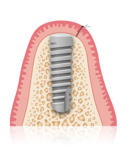 Ablauf Implantat und Qualität bei Praxis Dr. Kadir Aksogan, R
