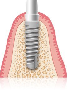 Ablauf Implantat und Qualität bei Praxis Dr. Kadir Aksogan, R