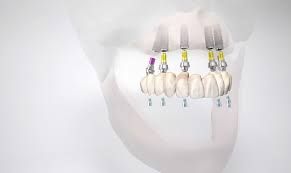 Implantate bei Praxis Dr. Kadir Aksogan, R