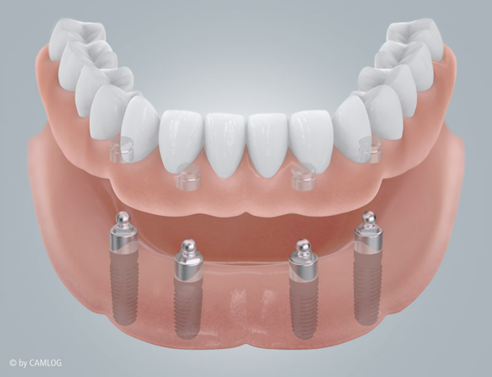 Modelguss Prothese, Labor Dr. Kadir Aksogan