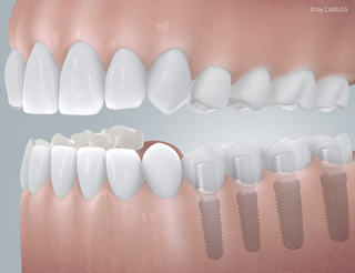 Implantat und Qualität bei Praxis Dr. Kadir Aksogan, R