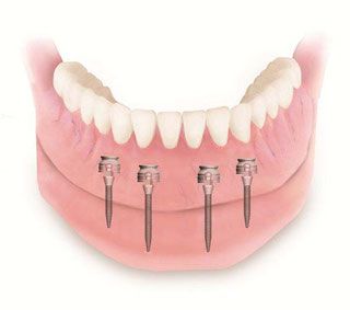 Mini Implantat und Qualität bei Praxis Dr. Kadir Aksogan, R