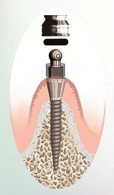 Mini Implantat und Qualität bei Praxis Dr. Kadir Aksogan, R