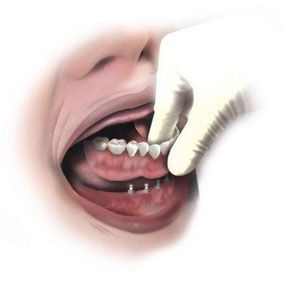 Mini Implantat und Qualität bei Praxis Dr. Kadir Aksogan, R