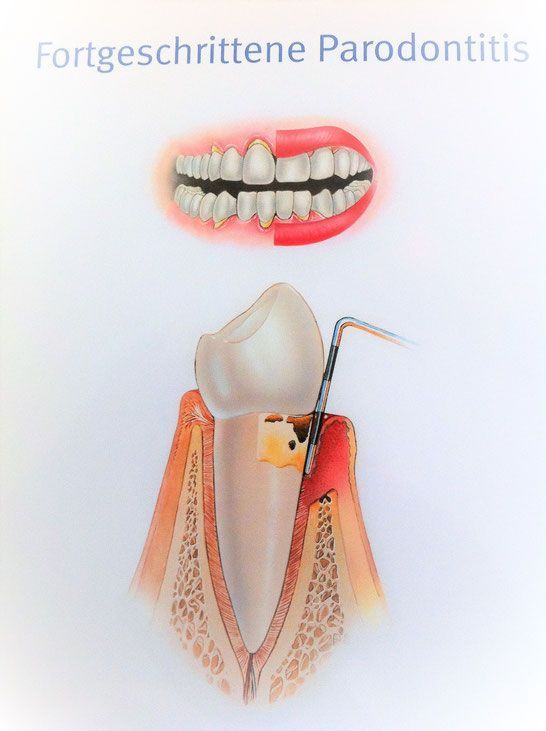 Zahnfleisch Kontrolle, Praxis Dr. Kadir Aksogan, GABA GmbH