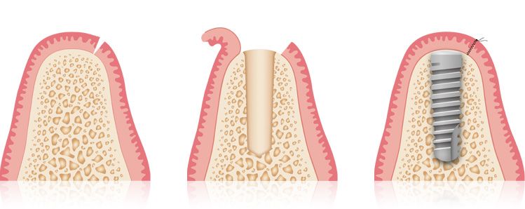Ablauf Implantat und Qualität bei Praxis Dr. Kadir Aksogan, R