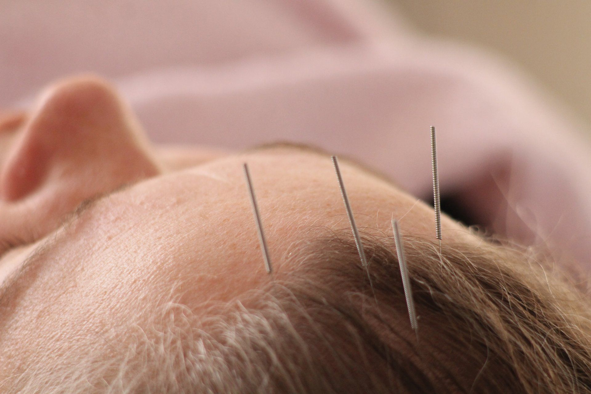 A lady patient having a scalp head acupuncture treatment