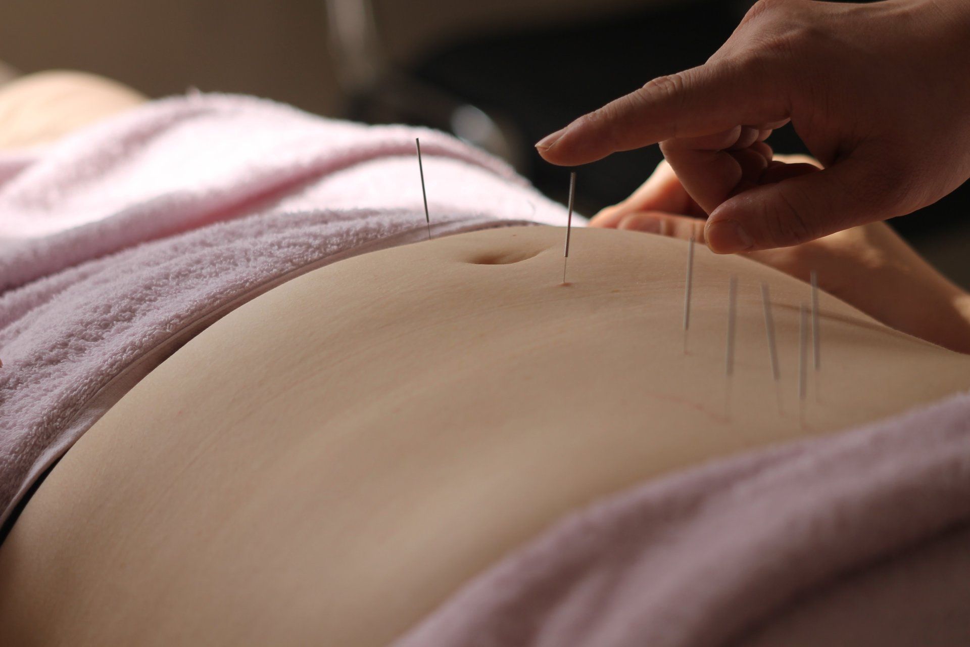 A patient having Acupuncture - A hand touching the tip of one of the needles