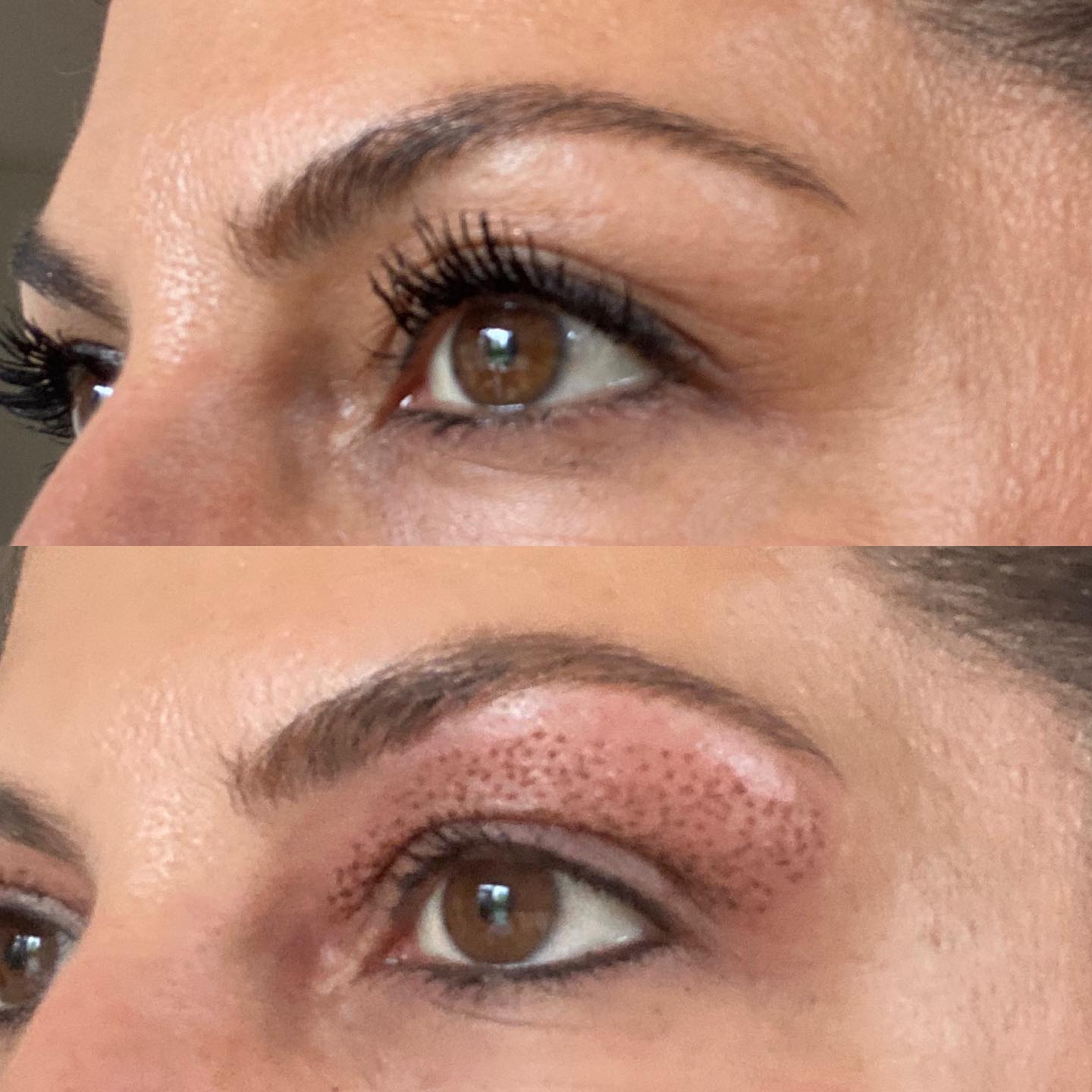 Ergebnis einer Plasma Pen Behandlung zur Oberlidstraffung – Straffung der Haut an den Oberlidern, Reduktion von Falten und ein frischer, jugendlicher Blick ohne Operation.