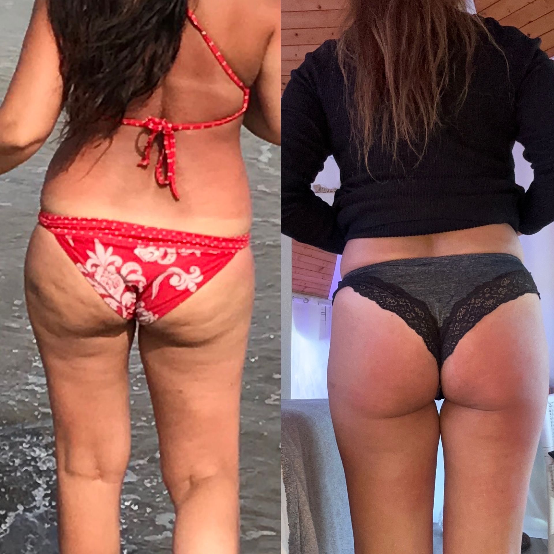 Ergebnis der Cellulite-Behandlung – Mit meiner liebevollen und professionellen Unterstützung setze ich Microneedling, Schröpfmassage und Elektrodenstimulation ein, um deine Haut zu straffen, das Bindegewebe zu festigen und die Faszien zu lockern. Du wirst eine glattere, straffere Haut erleben, die sich gesund und revitalisiert anfühlt. Noble Eye Kosmetik Halstenbek / Hamburg