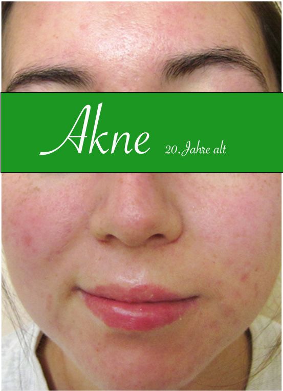 Aknebehandlung, Aknenarben, Akne, Teenager Akne,