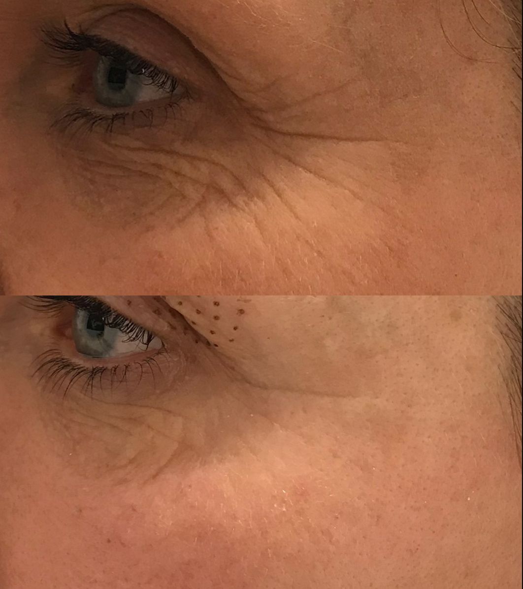 Diamond Lifting Vorher Nachher nur bei Noble Eye Anti Aging Sofort Sichtbar Diamond Lifting bei Noble Eye Faltenfrei