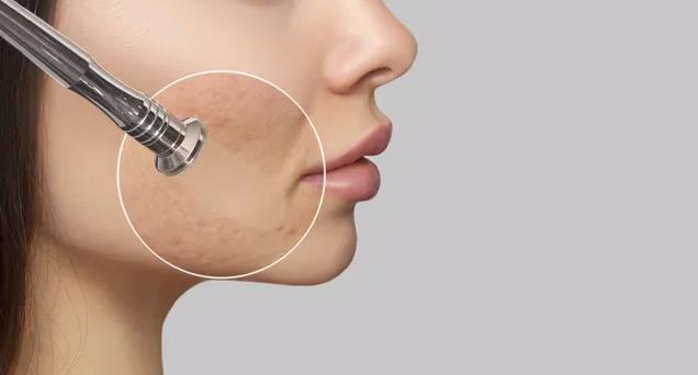 Microdermabrasion Microdermabrasion Halstenbek Hamburg Kosmetik