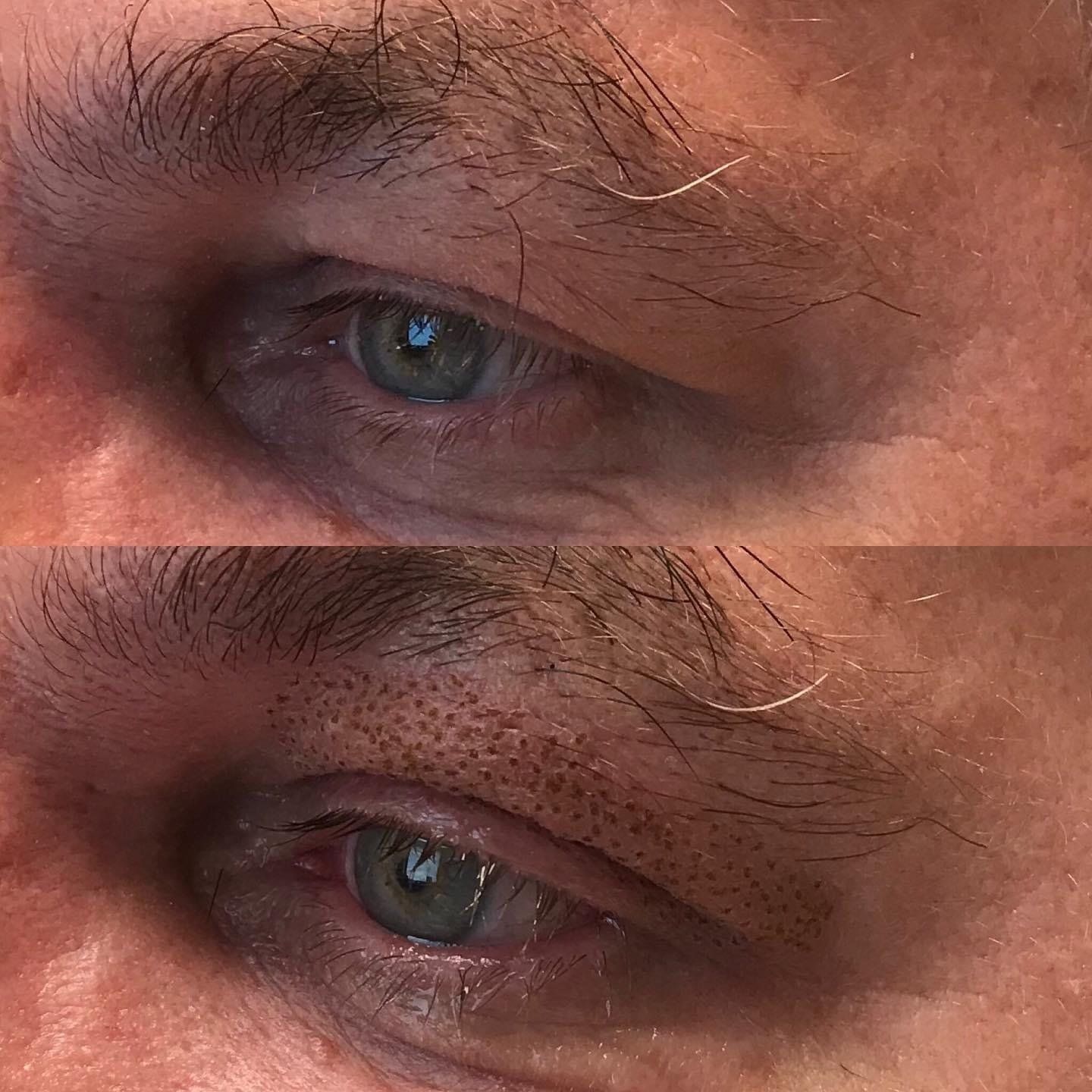 Plasma Pen Behandlung Oberlidstraffung Noble Eye Kosmetik Hamburg Halstenbek