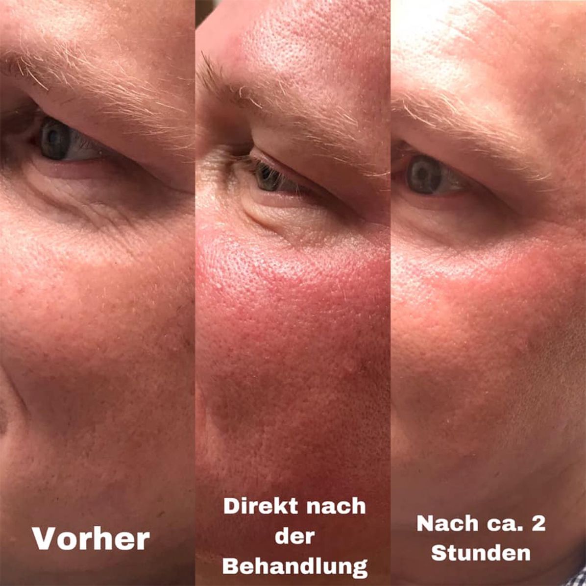 Soft Lifting Anti Aging Kosmetik Hamburg Halstenbek