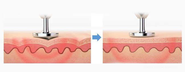 Soft Lifting Thermal Tip Soft Lifting Noble Eye Kosmetik Hamburg Halstenbek