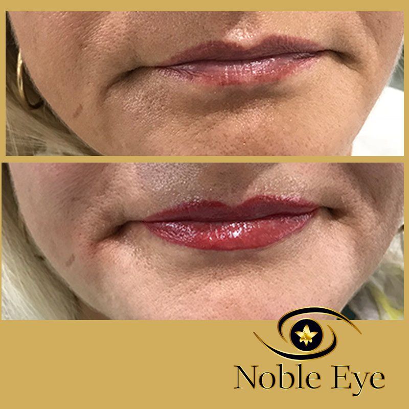 Plasma Pen Oberlidstraffung vorher nachher bei Noble Eye Plasma Pen Behandlung Oberlidstraffung Noble Eye Kosmetik Hamburg Halstenbek
