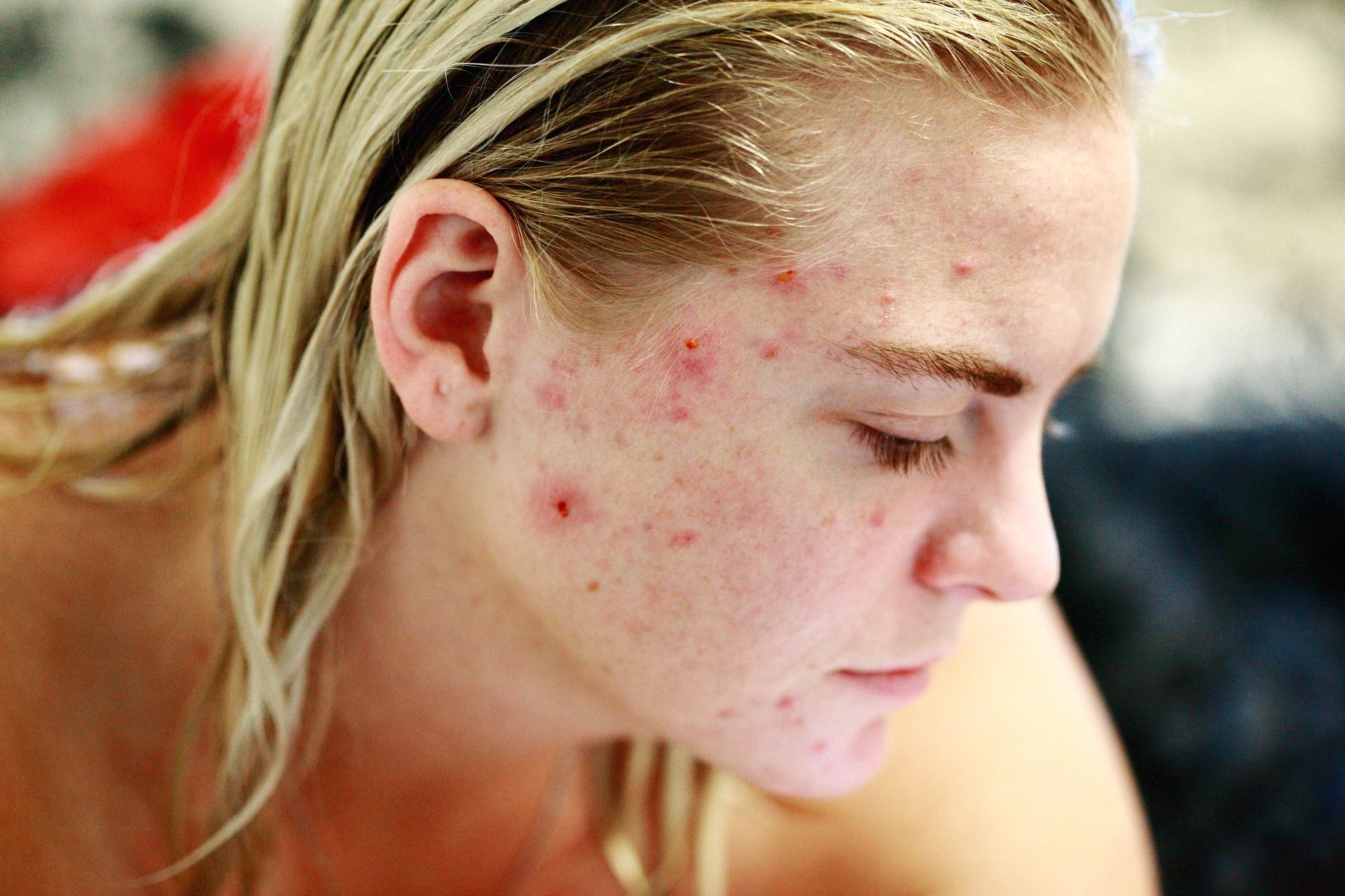 „Problemhaut-Behandlung Akne und Rosacea im Taunus