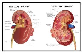 ESRD - End Stage Renal Disease - CKD - Chronic Kidney Disease - Primary Care Offices