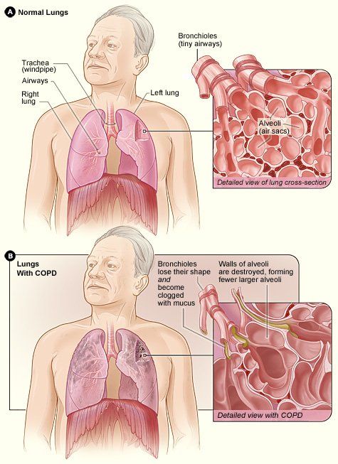 COPD - Chronic Obstructive Pulmonary Disease - Chronic Bronchitis - Emphysema - Primary Care Offices