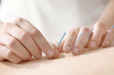 Acupuncture Page Acupuncture